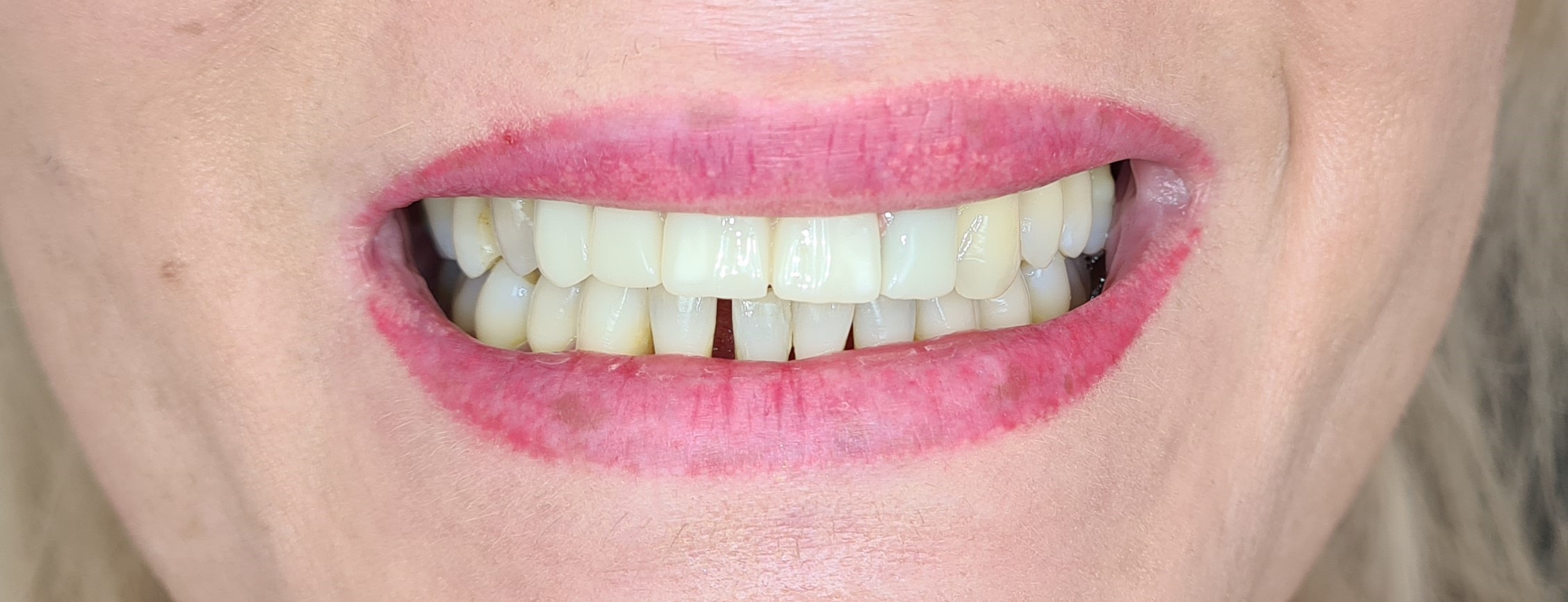 Extractie dentara dupa